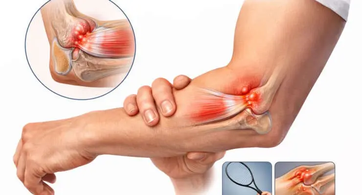 Έξω Επικονδυλίτιδα Αγκώνα (Tennis Elbow)
